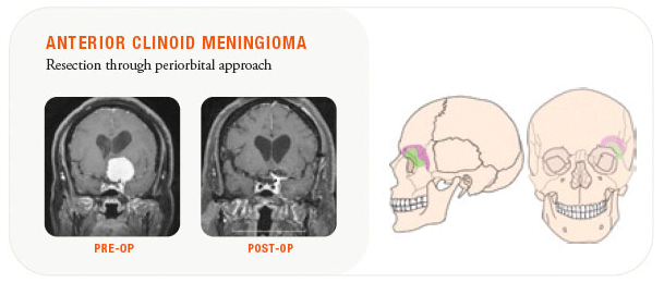 anterior clinoid medingioma, skull base cases