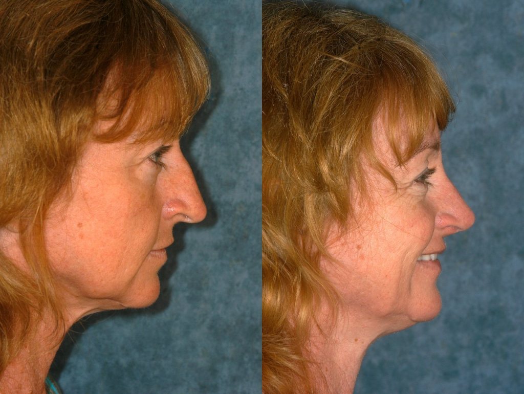 Before and After Rhinoplasty