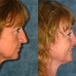 Before and After Rhinoplasty