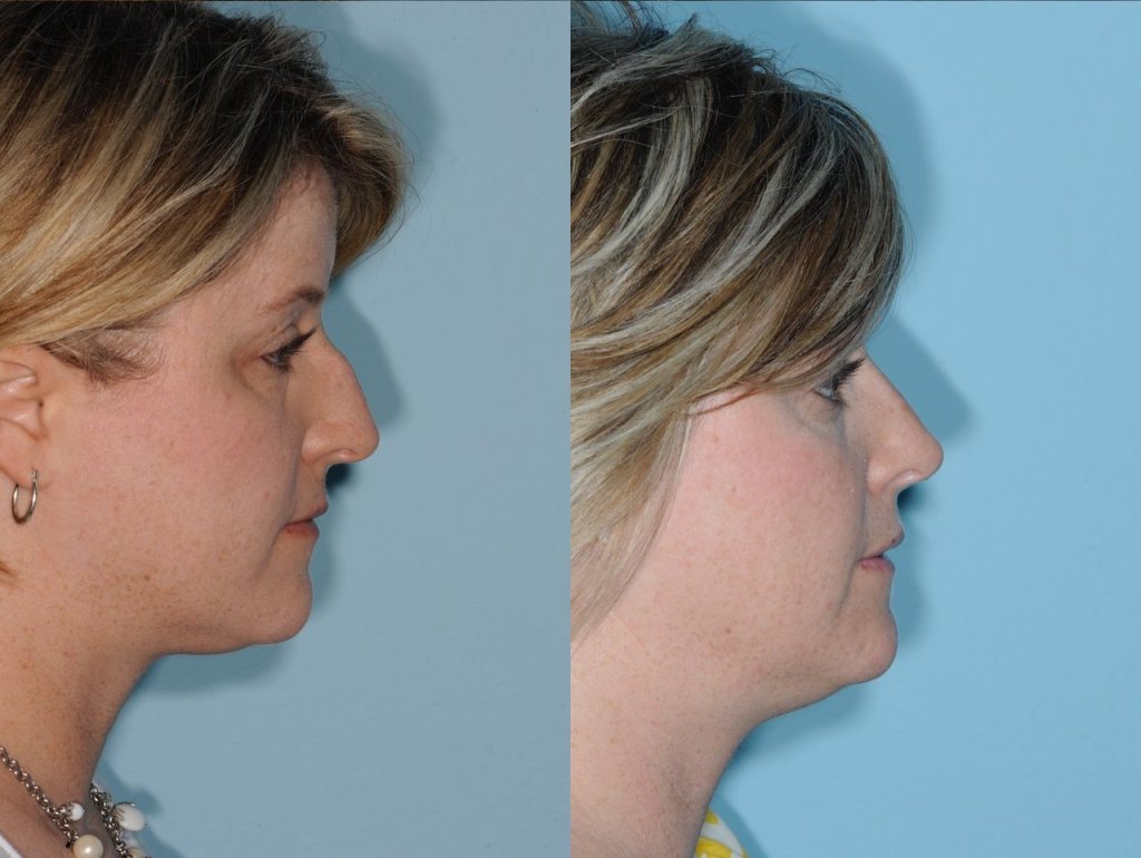 Before and After Rhinoplasty