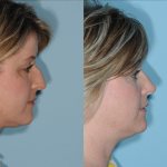 Before and After Rhinoplasty
