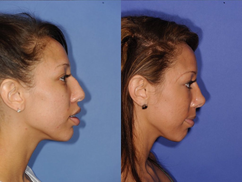 Before and After Rhinoplasty
