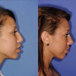 Before and After Rhinoplasty