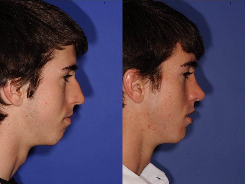 Before and After Rhinoplasty
