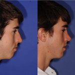 Before and After Rhinoplasty