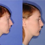 Before and After Rhinoplasty