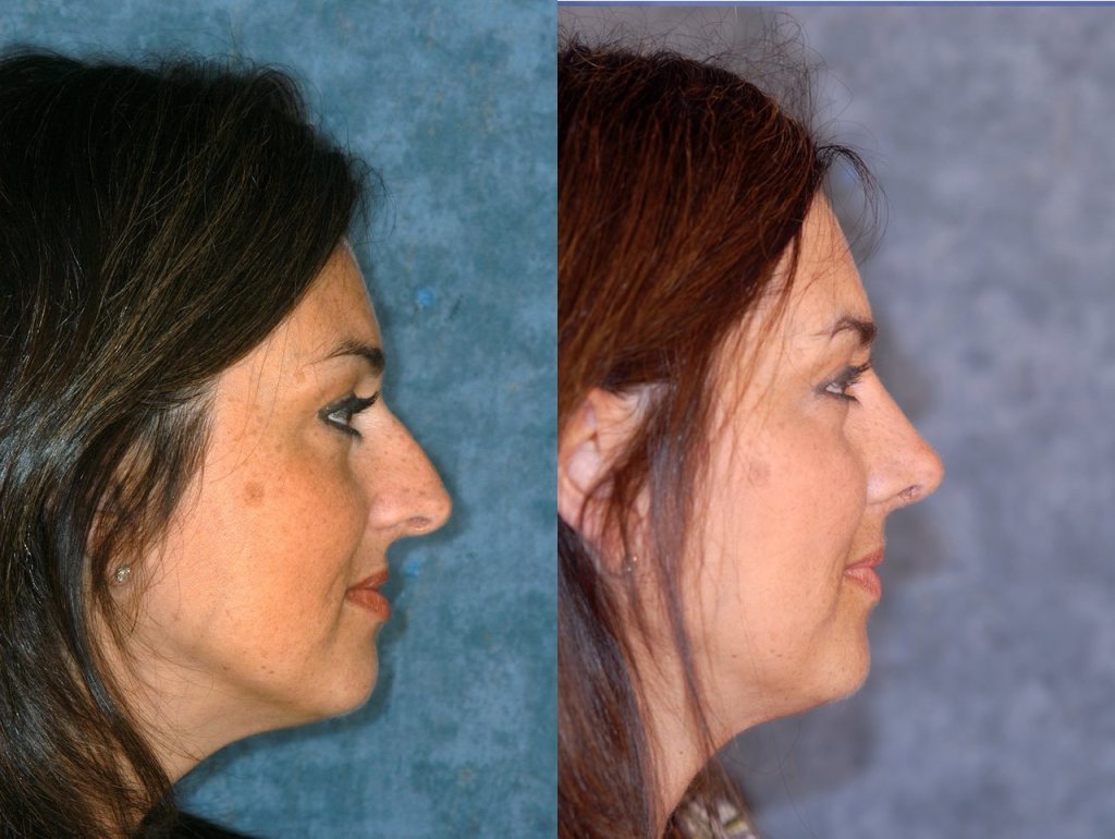 Before and After Rhinoplasty